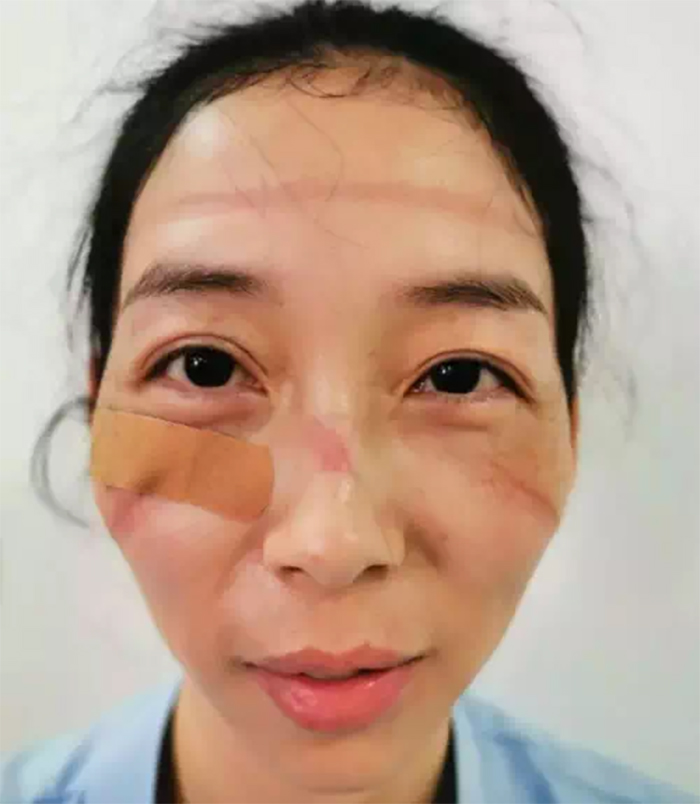 Chinese Nurses Share Pictures Of How Their Faces Look After Countless Hours Fighting The Coronavirus Chinese Nurses Share Pictures Of How Their Faces Look After Countless Hours Fighting The Coronavirus