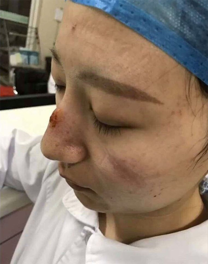 Chinese Nurses Share Pictures Of How Their Faces Look After Countless Hours Fighting The Coronavirus Chinese Nurses Share Pictures Of How Their Faces Look After Countless Hours Fighting The Coronavirus