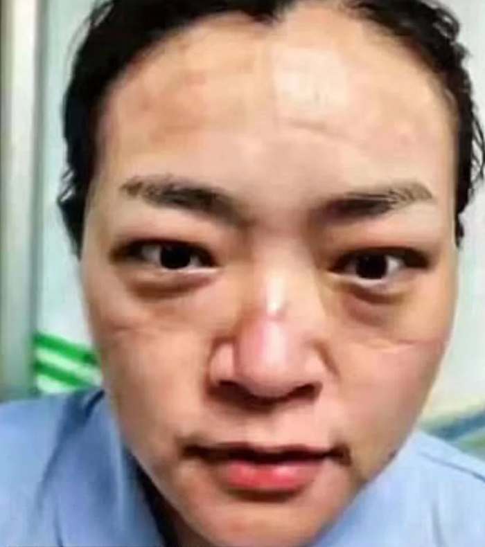 Chinese Nurses Share Pictures Of How Their Faces Look After Countless Hours Fighting The Coronavirus Chinese Nurses Share Pictures Of How Their Faces Look After Countless Hours Fighting The Coronavirus