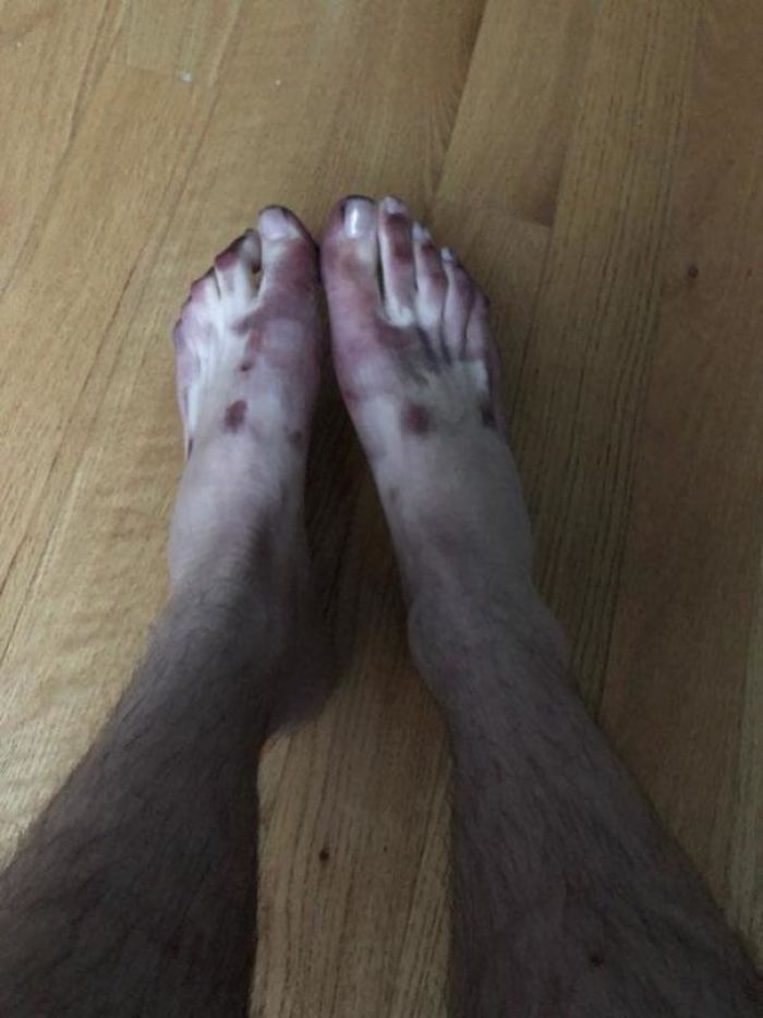 My Coworkers Feet After A Cab Rode Over Them