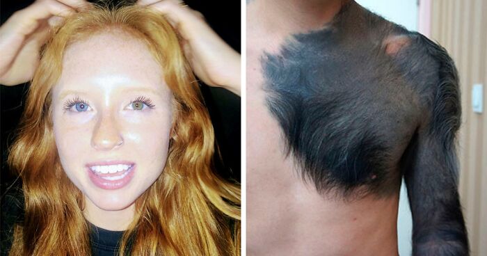 39 People Whose Genetics Made Them Unique