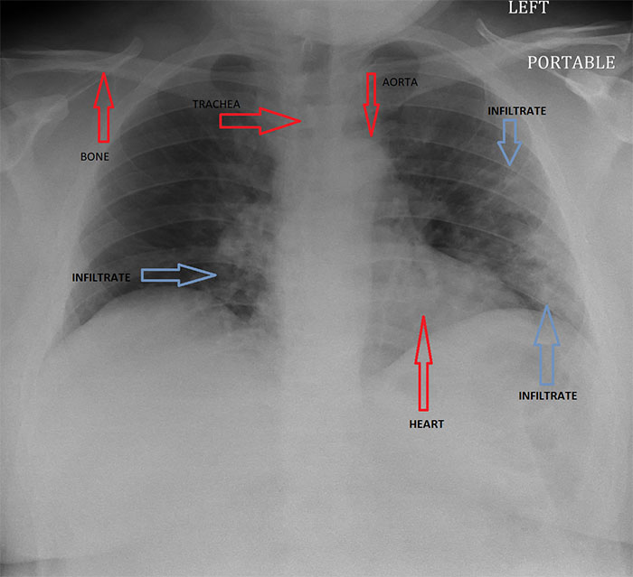 Angry Radiologist Asks To Share His Message After A Potential Coronavirus Carrier Takes A Plane Full Of People Angry Radiologist Asks To Share His Message After A Potential Coronavirus Carrier Takes A Plane Full Of People