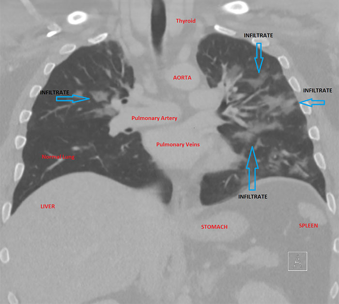 Angry Radiologist Asks To Share His Message After A Potential Coronavirus Carrier Takes A Plane Full Of People Angry Radiologist Asks To Share His Message After A Potential Coronavirus Carrier Takes A Plane Full Of People