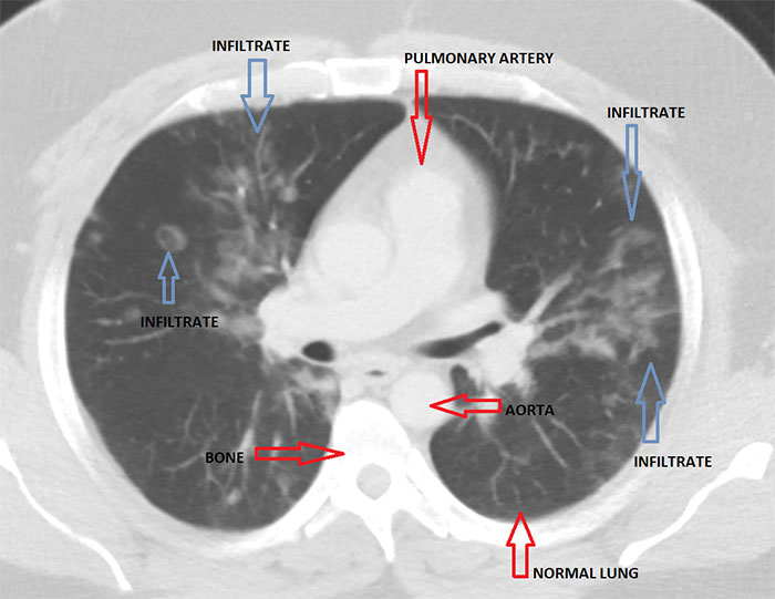 Angry Radiologist Asks To Share His Message After A Potential Coronavirus Carrier Takes A Plane Full Of People Angry Radiologist Asks To Share His Message After A Potential Coronavirus Carrier Takes A Plane Full Of People