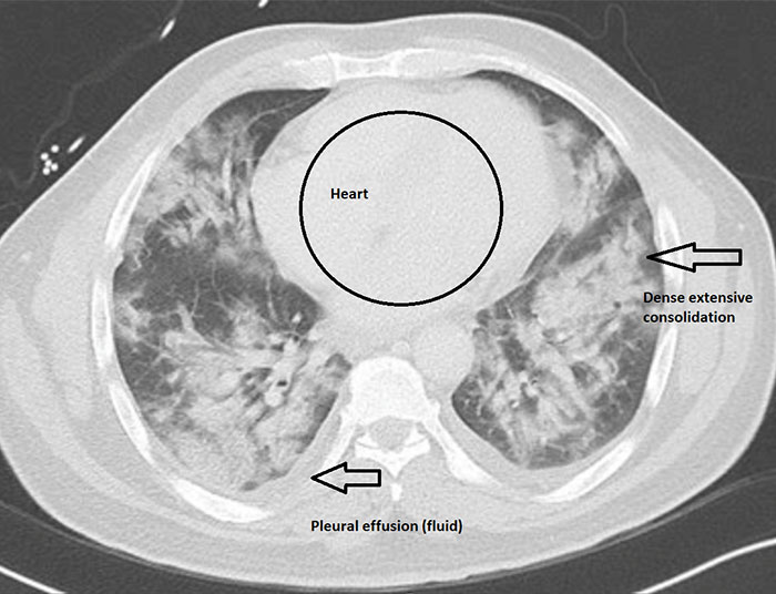 Angry Radiologist Asks To Share His Message After A Potential Coronavirus Carrier Takes A Plane Full Of People Angry Radiologist Asks To Share His Message After A Potential Coronavirus Carrier Takes A Plane Full Of People