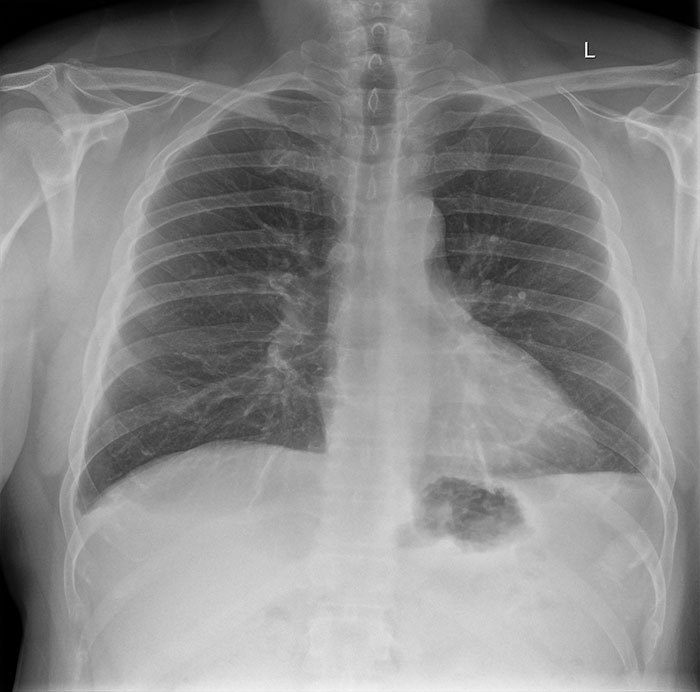 Man Details What It Really Feels Like To Have A 'Mild' Case Of Covid-19