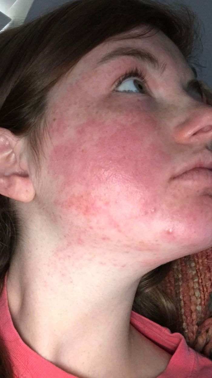 Did Y’all Know That A Small Percentage Of The Population Is Allergic To Mango? Yeah, Me Neither