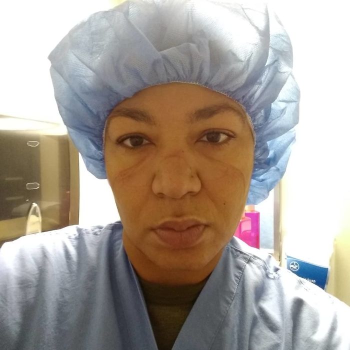 Nurse Shows What Wearing An N95 Mask For A Prolonged Period Does To Your Face