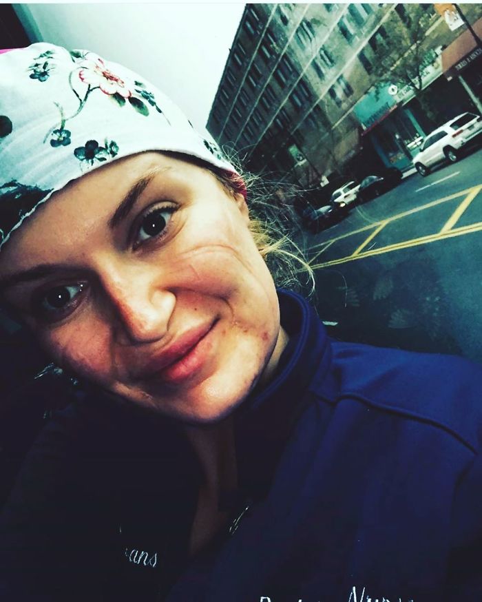A Medical Care Worker Shows Marks Left By The Face Mask