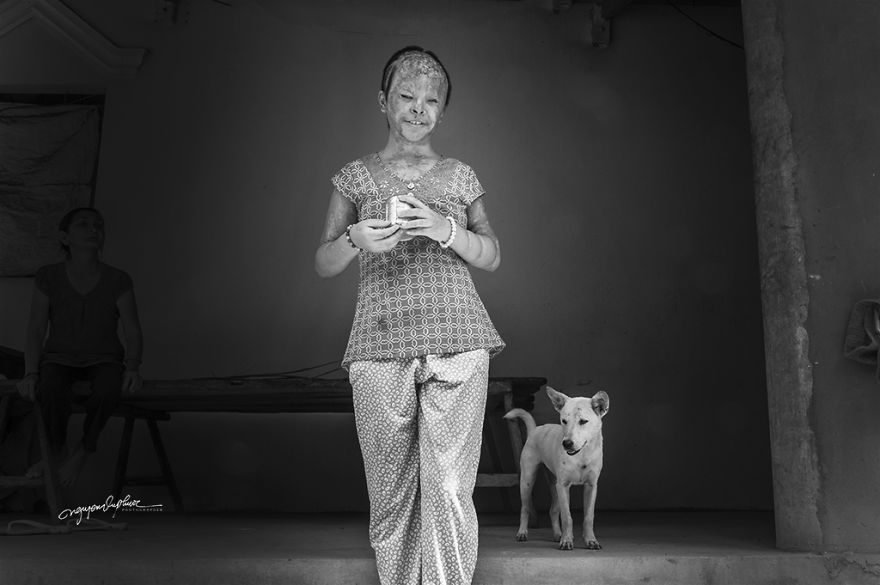 Abandoned Child Faces Gloomy Future Because Of Acid Attack Abandoned Child Faces Gloomy Future Because Of Acid Attack