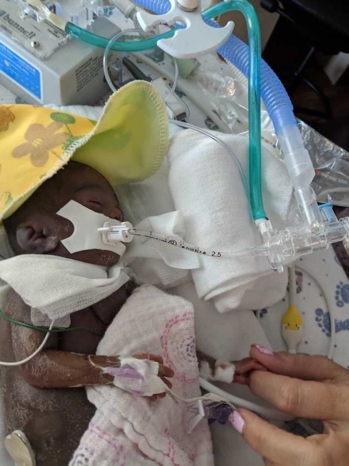 "I Adopted A 'Perfect' Micro-Preemie & Was By His Side As He Died 8 Days Later" "I Adopted A 'Perfect' Micro-Preemie & Was By His Side As He Died 8 Days Later"