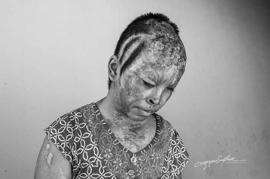 Abandoned Child Faces Gloomy Future Because Of Acid Attack Abandoned Child Faces Gloomy Future Because Of Acid Attack