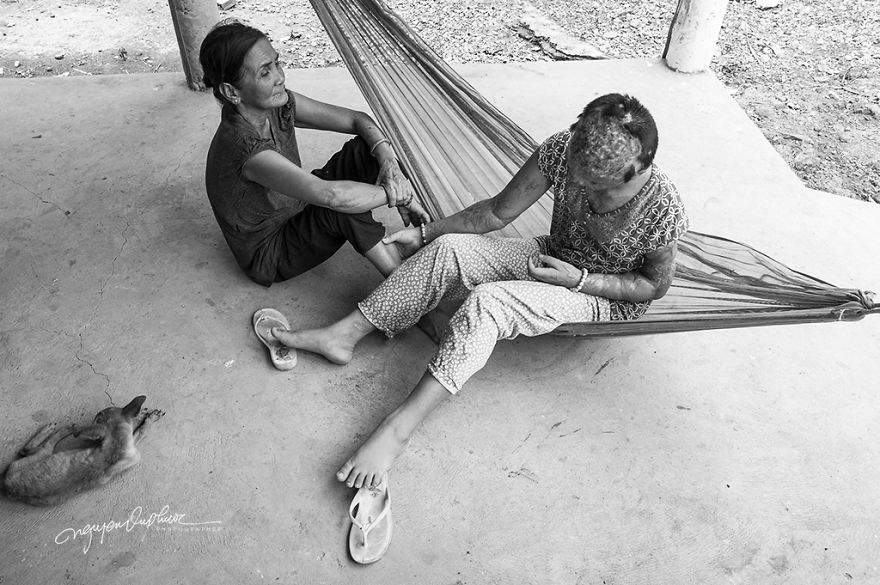 Abandoned Child Faces Gloomy Future Because Of Acid Attack Abandoned Child Faces Gloomy Future Because Of Acid Attack