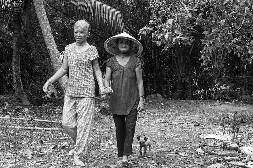 Abandoned Child Faces Gloomy Future Because Of Acid Attack Abandoned Child Faces Gloomy Future Because Of Acid Attack