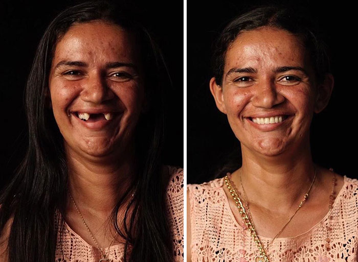 Brazilian Dentist Travels To Fix The Teeth Of Less-Fortunate People For Free And Here Are 30 New Transformations