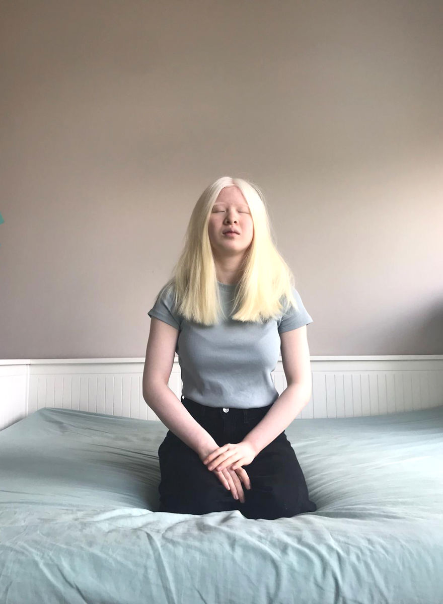 Models With Disabilities And Visbible Differences Take Part In Unique Photoshoots At Home. Project Isolation.