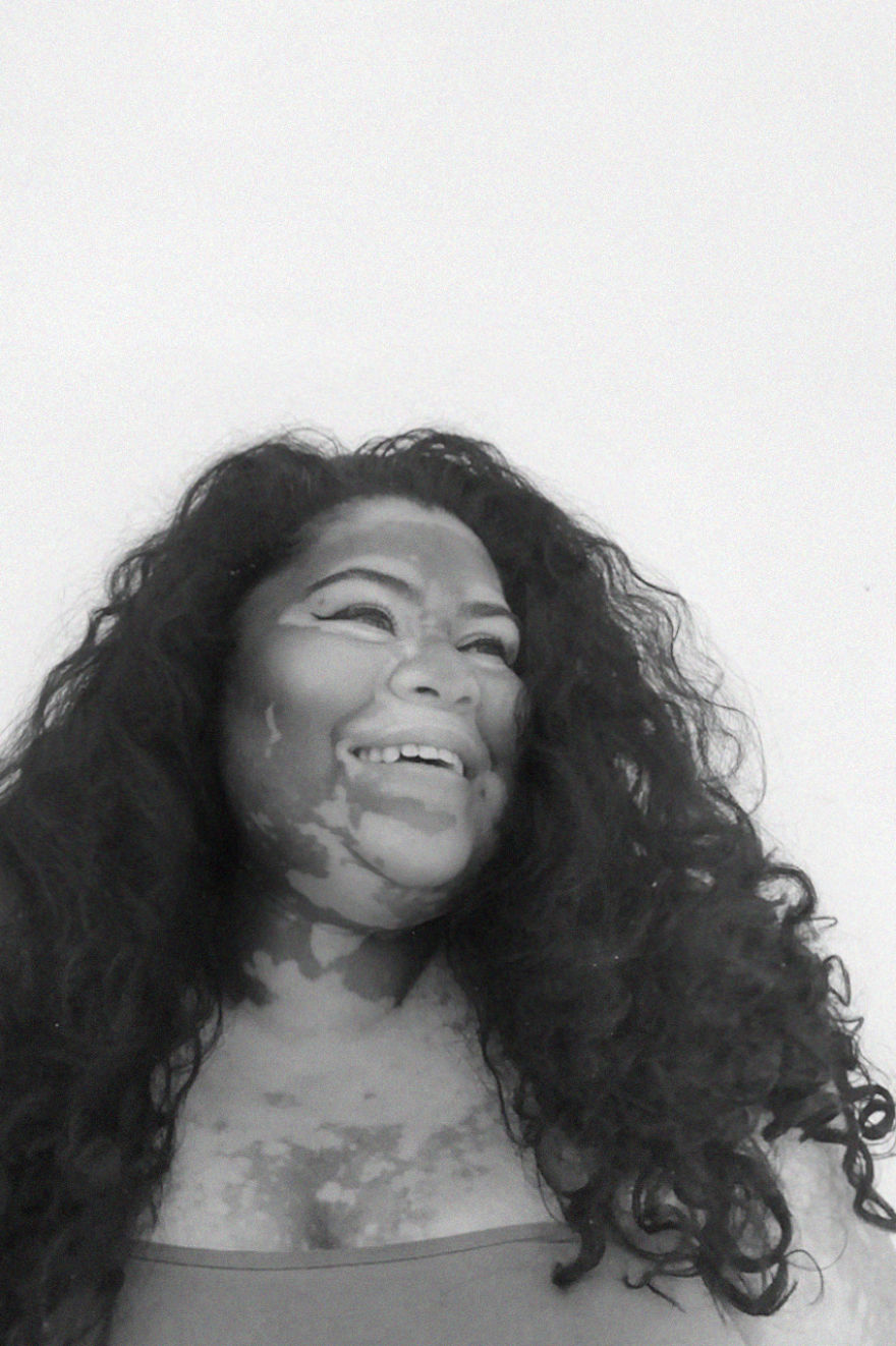 Models With Disabilities And Visbible Differences Take Part In Unique Photoshoots At Home. Project Isolation.