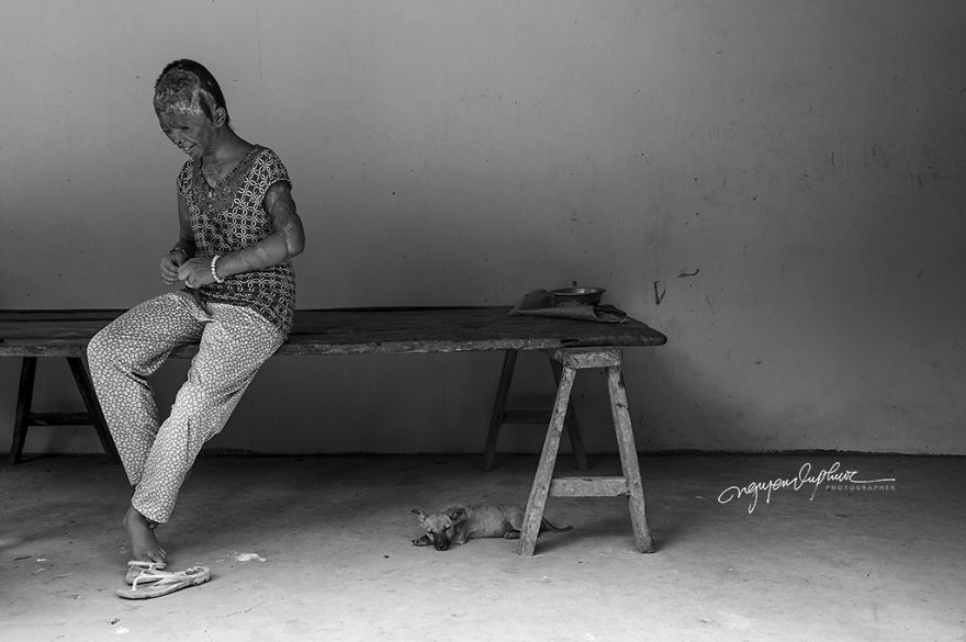 Abandoned Child Faces Gloomy Future Because Of Acid Attack Abandoned Child Faces Gloomy Future Because Of Acid Attack