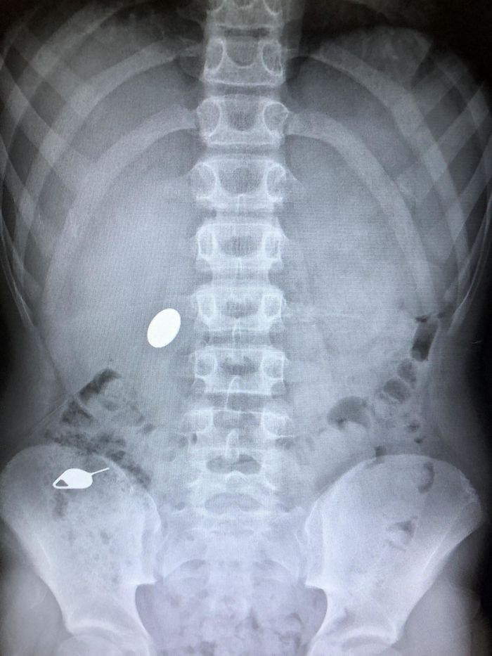 My Kid Swallowed A Penny While Showing His Little Brother How He Accidentally Swallowed A Sim Key The Day Before