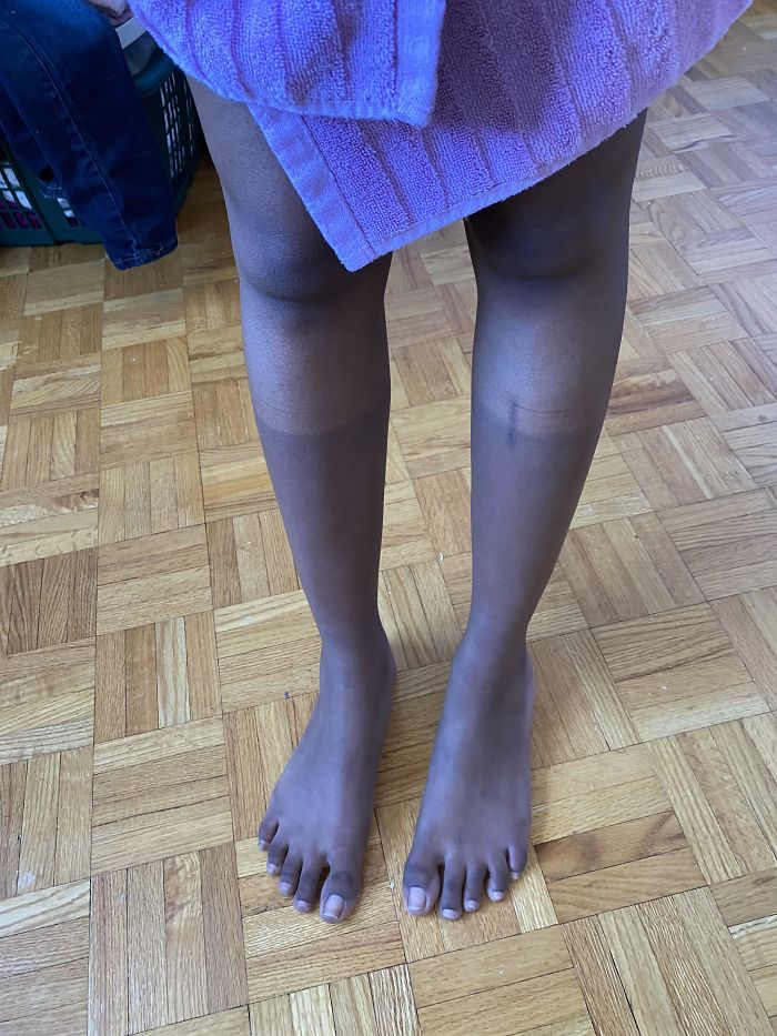 I Spent A Little Too Much Time Outside While Wearing 3/4 Pants