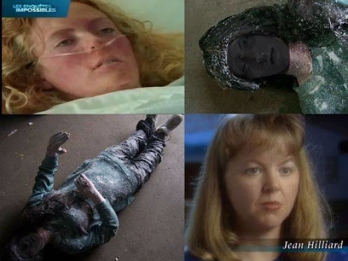 In 1980 Jean Hilliard’s Body Was Discovered Frozen Solid. Drs Saw No Signs Of Life And Couldn’t Give Her An Injection Coz She Was So Frozen. Miraculously As Her Body Started To Thaw She Managed To Make Some Movements. Within 6 Weeks She Was Back To Full Health