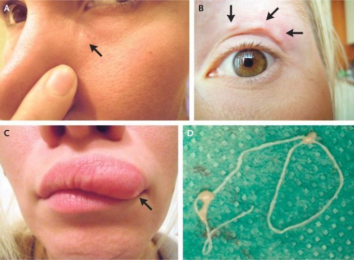 Eww Shudder. A Woman Had A Lump Under Her Which Moved To Above Her Eye Then To Her Lip. Drs Discovered A Thread Like Worm Often Found In Pets And Wild Animals. It Is Believe She Got It From A Mosquito Bite