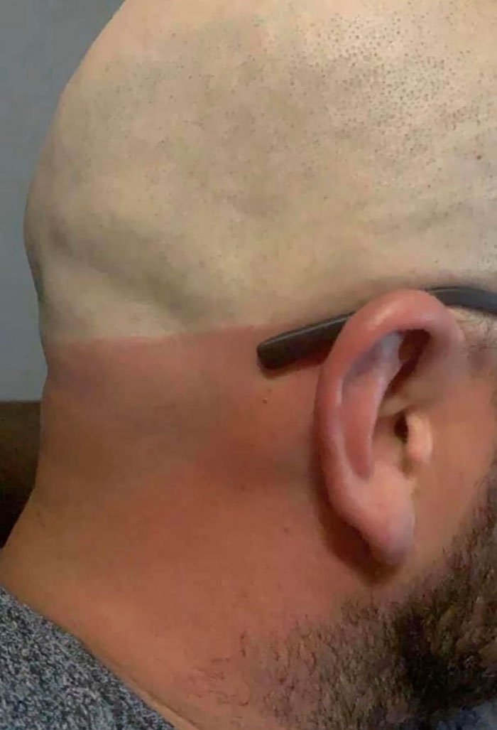 Pale Person Problems