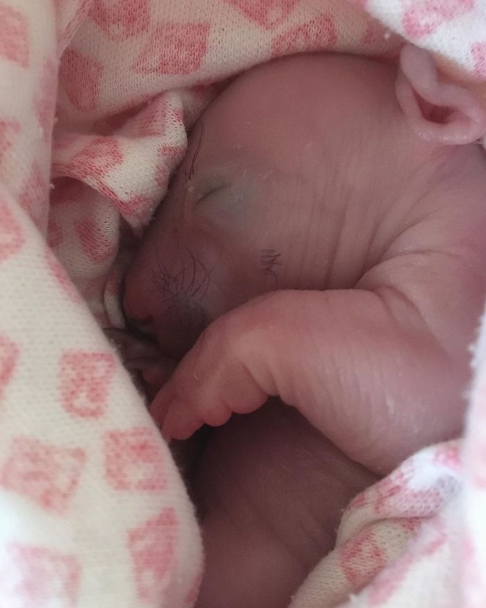 An Orphaned Baby Wombat Was Found In Her Dead Mother's Pouch Weighing Just 120 Grams, Got Rescued