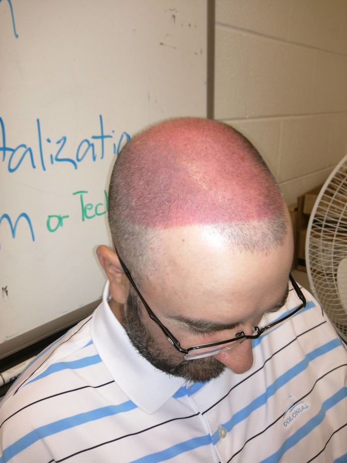Co-Worker Shaved His Head, Then Went Golfing, And Decided To Wear A Visor