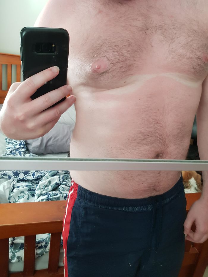 I Realized I Need To Lose Some Weight When I Sat Out In The Sun And My Manboobs Gave Me A "Bra" On My Sunburned Torso