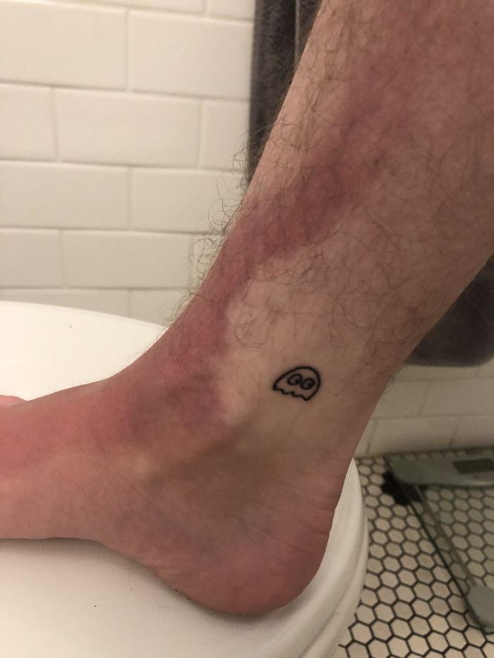 Went To The Beach And Put Extra Sunscreen On My Tattoos To Be Safe. Guess I Forgot To Keep The Rest Of That Area Safe As Well