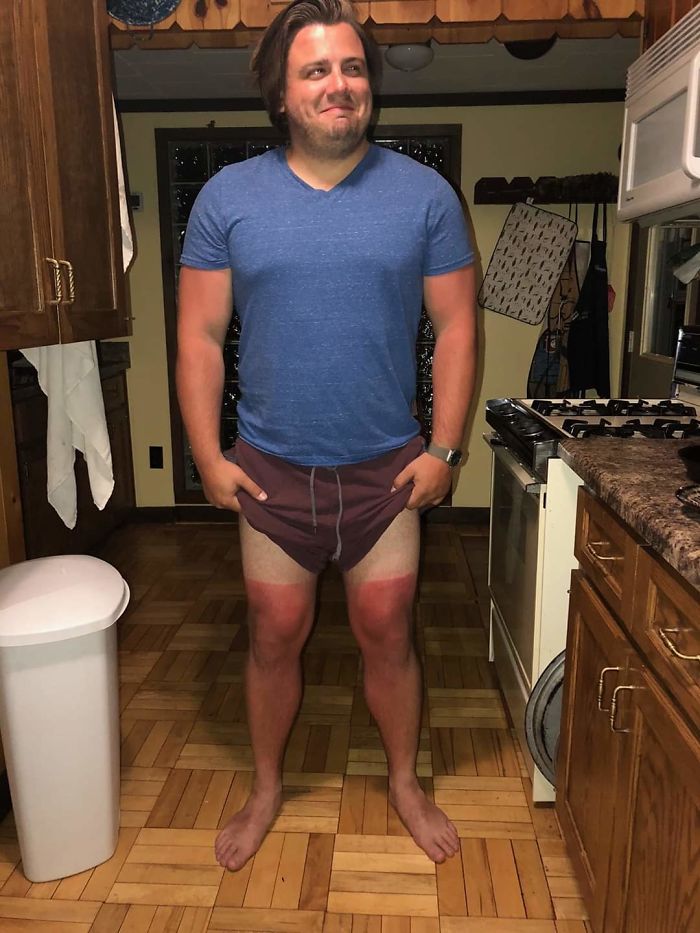 Well... It's Sunburn Season