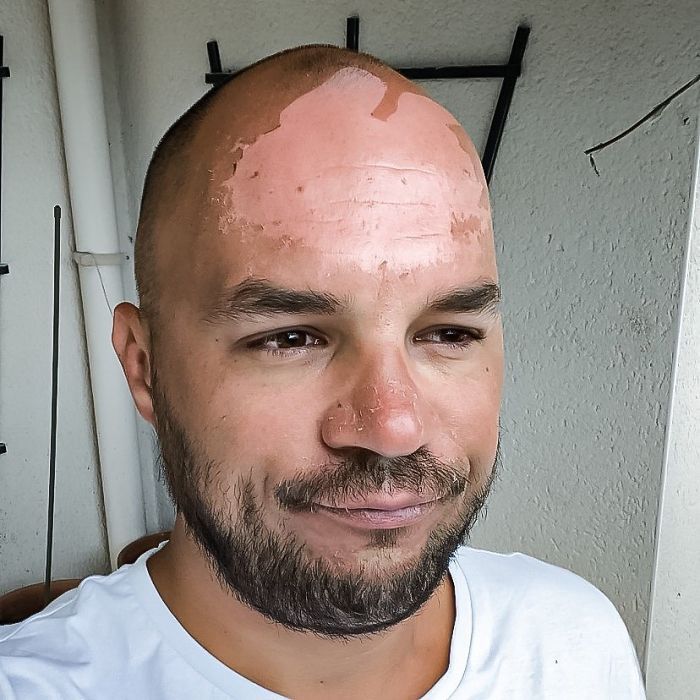 And There It Is... 3 Days In Full Sun, Clearly Not Enough Sun Protection, And A Big Forehead