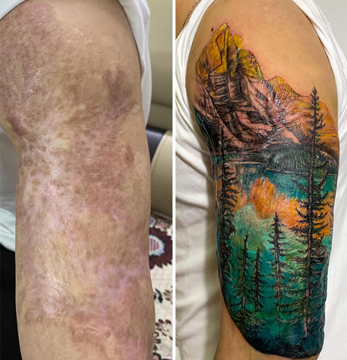 Tattoo artist covers up arm scar with a vibrant woodland landscape design.