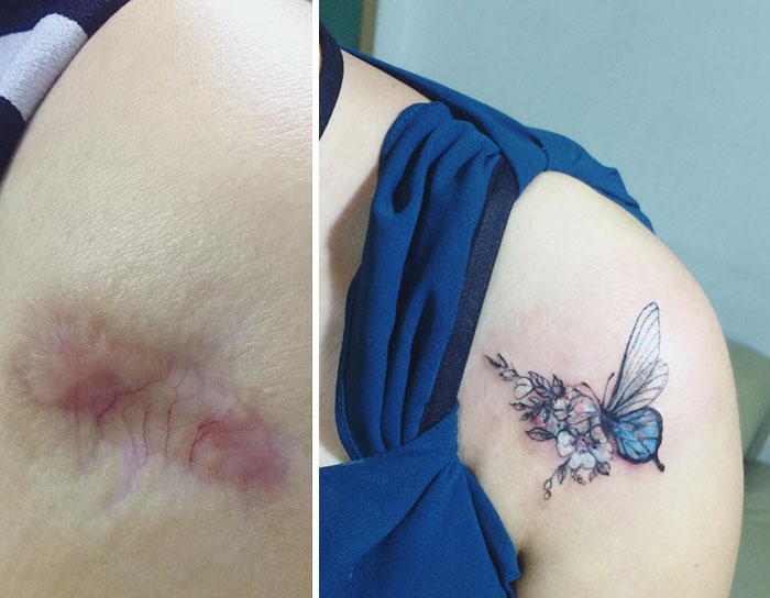 Tattoo covers a scar with a butterfly and flower design on a woman's shoulder.