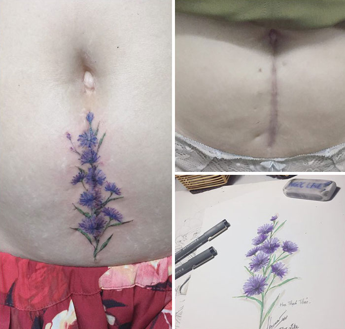 Tattoo art covering scars; botanical design on skin, with sketch and healed scar transformation.