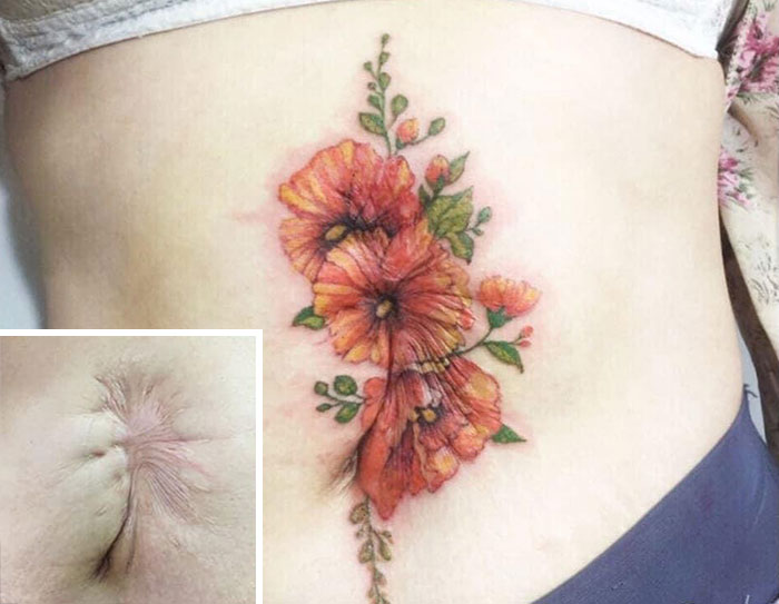 Floral tattoo expertly covering scar on skin.