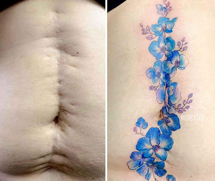 Tattoo artist transforms a scar into blue floral artwork.