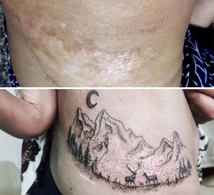 Tattoo artist transforms scars into a mountain scene with trees and a crescent moon.