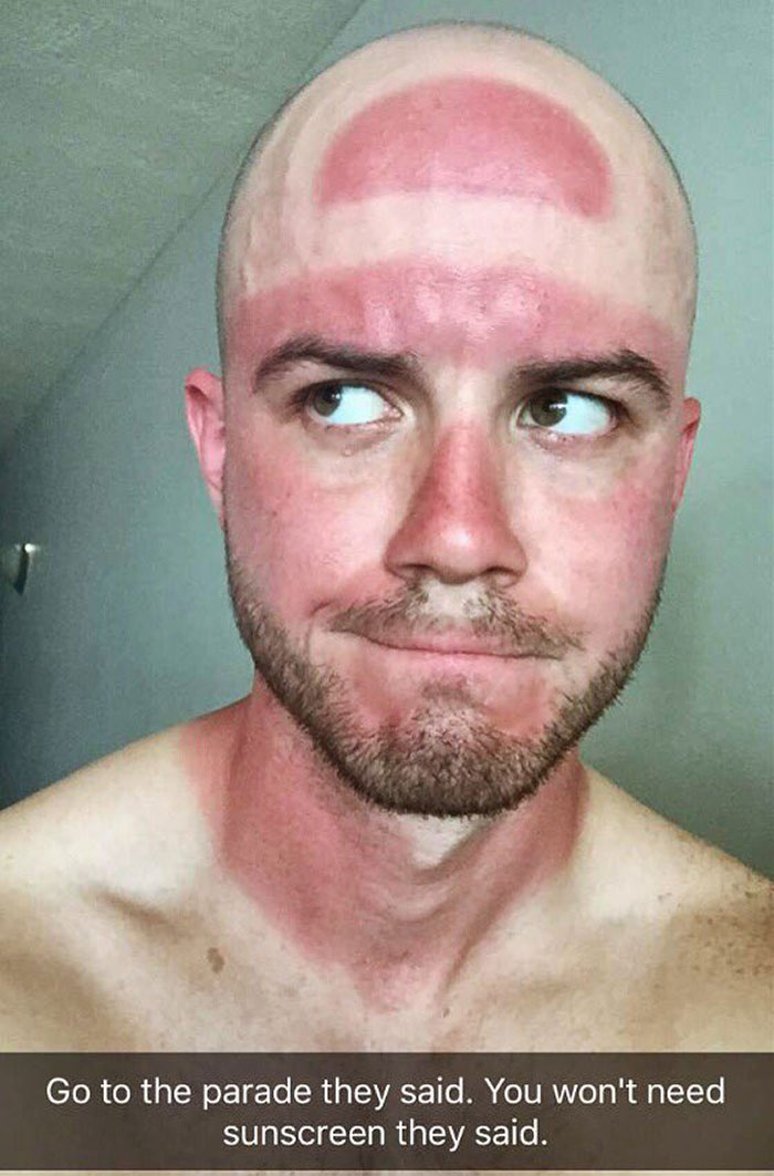 Who Needs A Farmer's Tan When You Can Get A Cavs Finals Hat Burn