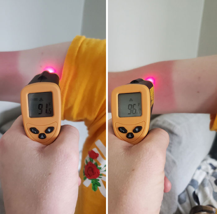 Wear Sunblock - Temperature Of Burned And Unburned Skin