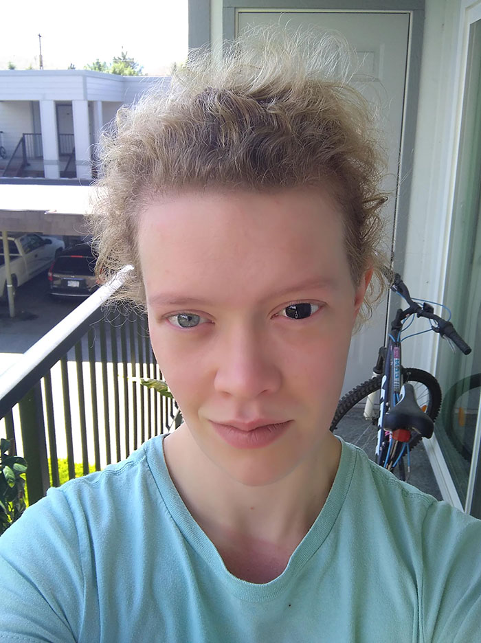 My Contact Lenses Darken In The Sun. Here's A Comparison To Show It