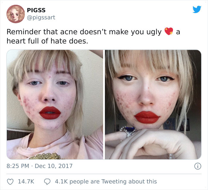 'I'm Sure I'd Feel The Same Way If I Was A Skinny White Girl': Person Attacks A Girl With Acne, Gets Put In Their Place Immediately 'I'm Sure I'd Feel The Same Way If I Was A Skinny White Girl': Person Attacks A Girl With Acne, Gets Put In Their Place Immediately