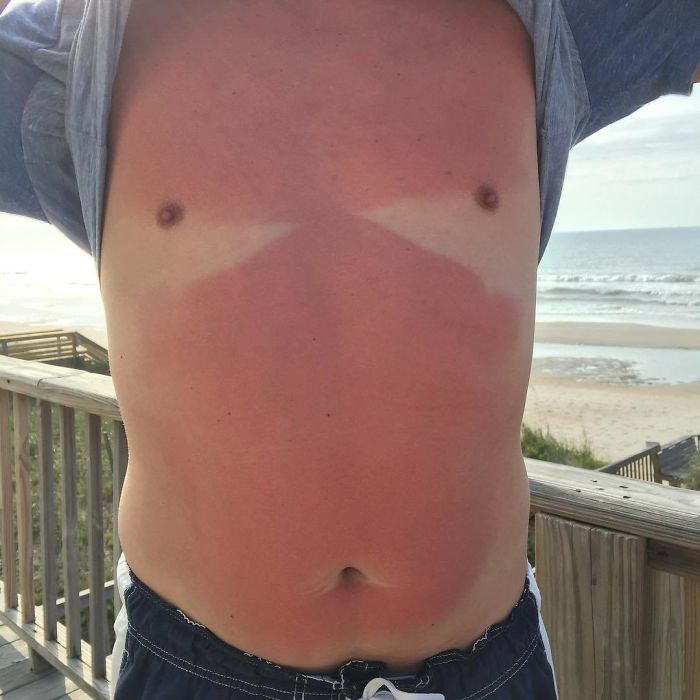 My Husband Got A Little Burnt. The Sun Missed A Couple Spots