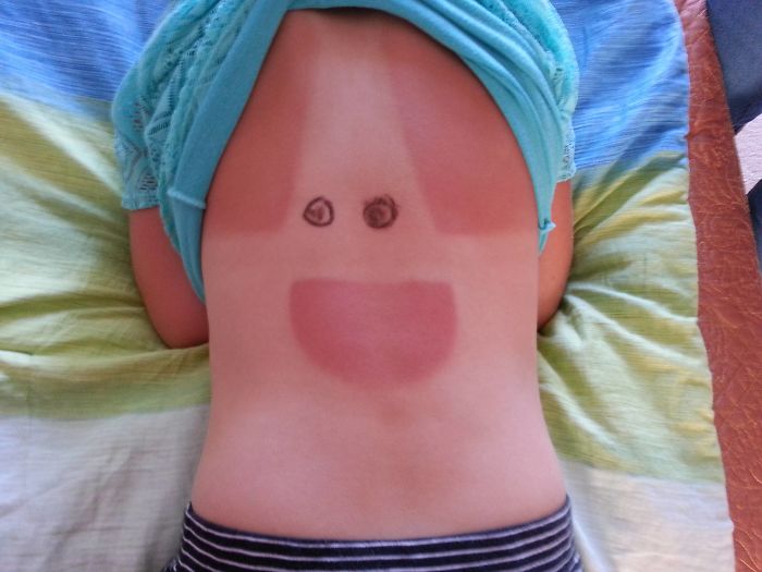 Daughter's Sunburn Looks Like Patrick From Spongebob