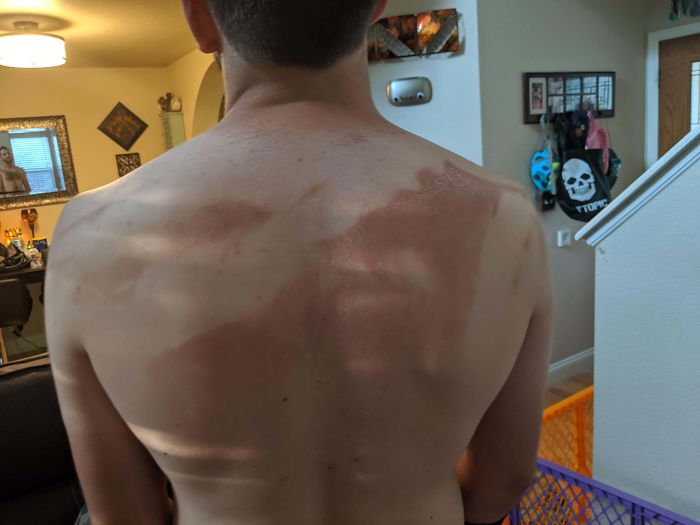 What Could Go Wrong If You Say You Don't Need Any Help Putting Sunscreen On Your Back