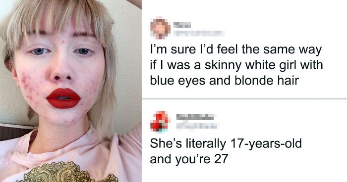 ‘I’m Sure I’d Feel The Same Way If I Was A Skinny White Girl’: Person Attacks A Girl With Acne, Gets Put In Their Place Immediately
