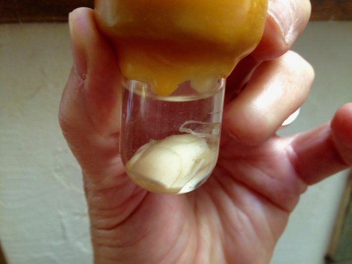 My Finger I Tore Off In An Accident 12 Years Ago.