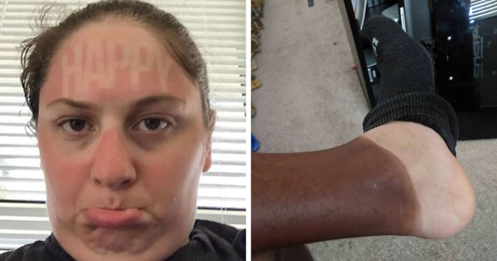 “Always Wear Sunscreen!”: 40 People Who Failed To Do It And Ended Up Looking Like Dorks