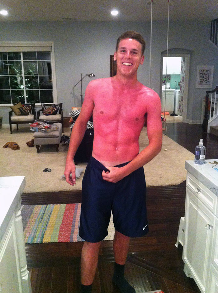 My Cousin Got A Sunburn